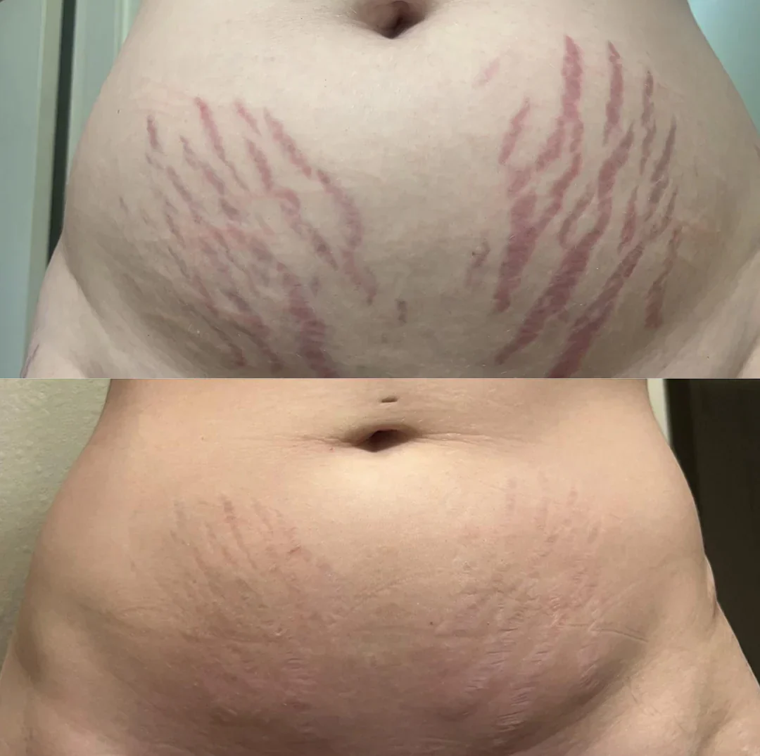 ScarRefine – Erase Scars & Restore Texture + 50% OFF TODAY - Image 7