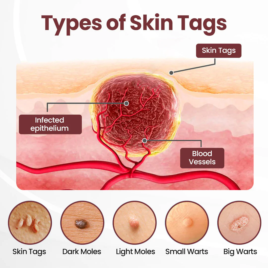 The KeraErase Dual-Action Cream - Non-Acidic Renewal for Warts, Tags, and Keratin Buildup + 50% OFF - Image 3